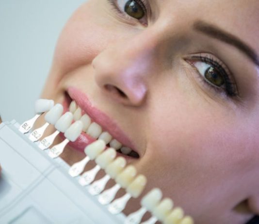 Kako pogoditi savršenu boju bezmetalne krunice za potpuno prirodan izgled navlake-za-zube